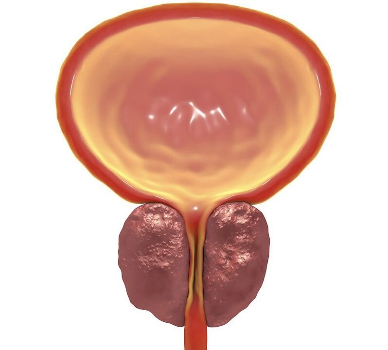 chronic prostatitis inflammation