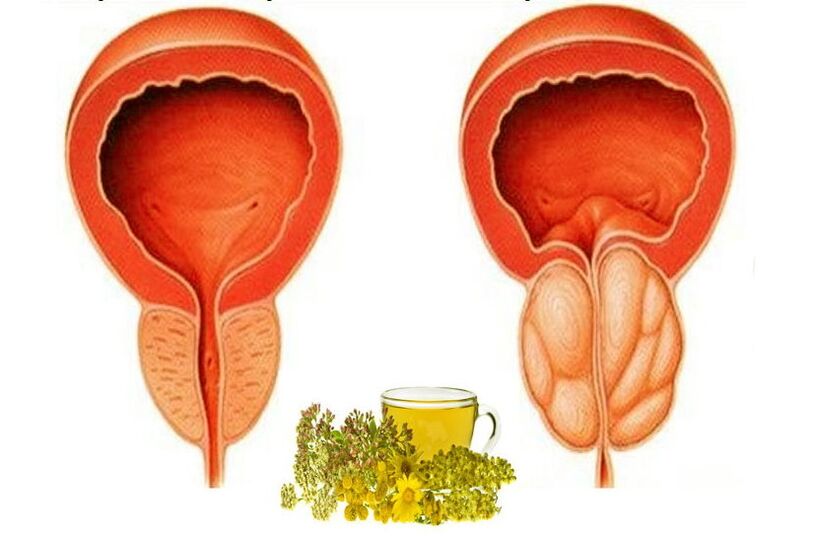 A healthy and sick prostate