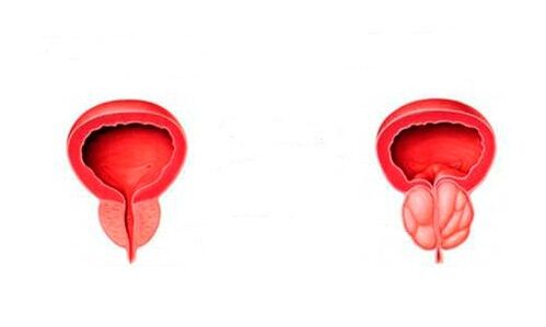healthy prostate and inflamed with prostatitis