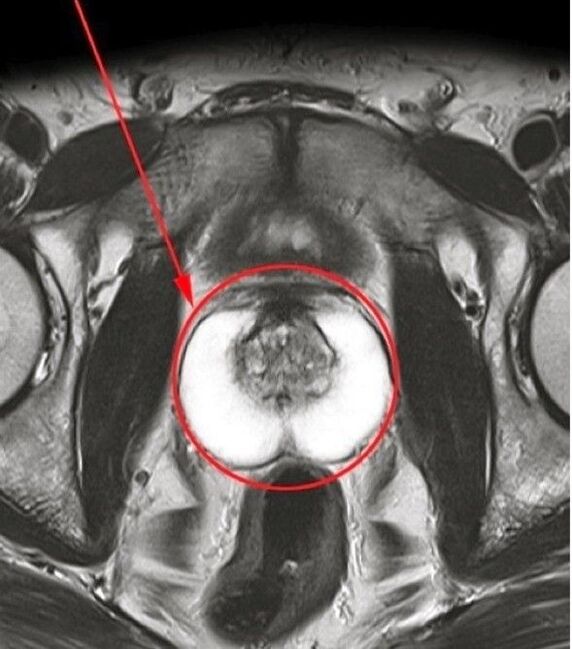 prostate picture after using Predstonorm capsules